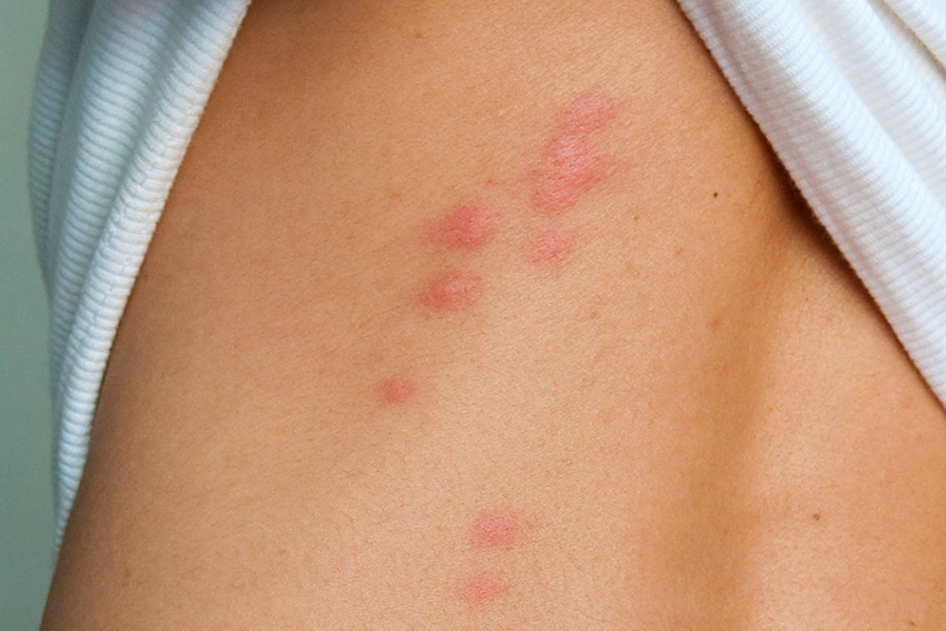 Detail Photo Bed Bug Nomer 33