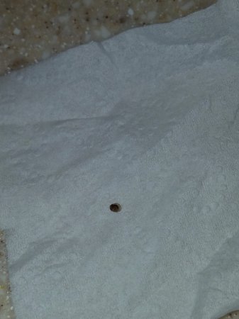 Picture Of Kidney Stone In Toilet - KibrisPDR