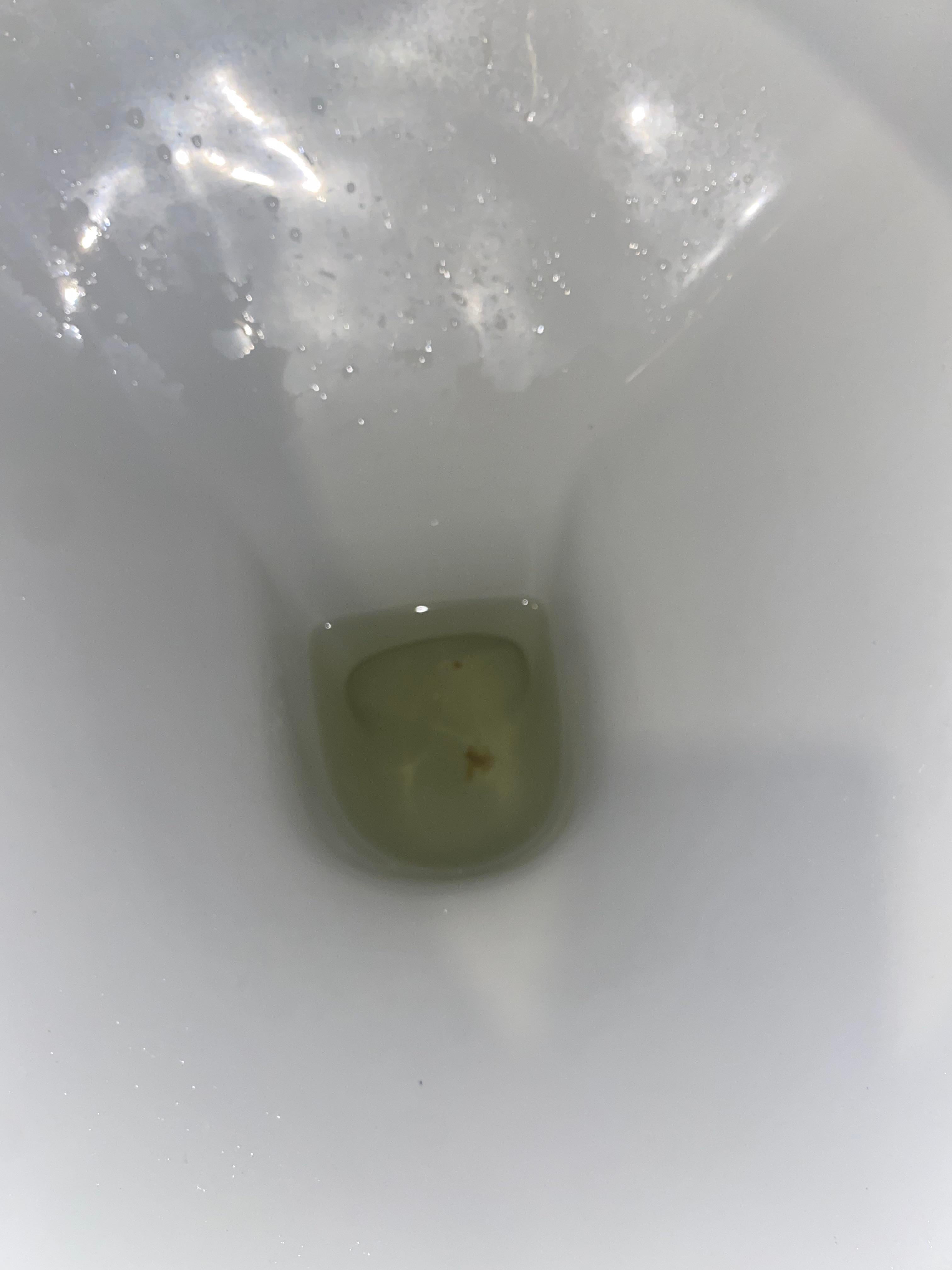 Detail Picture Of Kidney Stone In Toilet Nomer 12