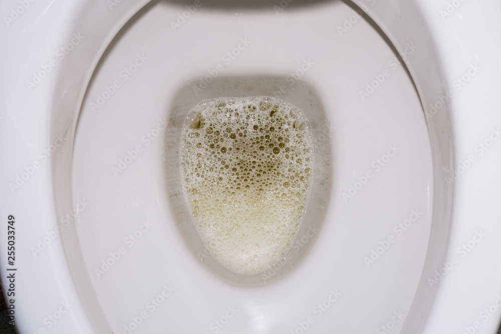 Detail Picture Of Kidney Stone In Toilet Nomer 7