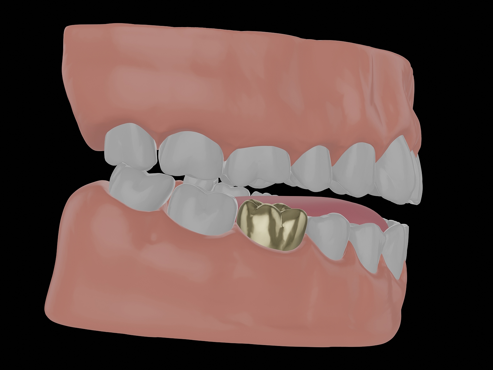 Detail Pictures Of Tooth Nomer 28