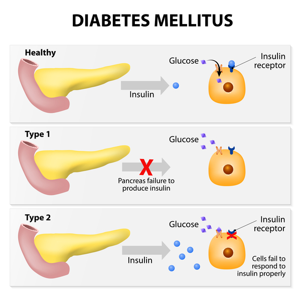 Detail Diabetes Melitus Dan Insipidus Nomer 29