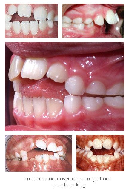Rainbow Teeth From Pacifier - KibrisPDR