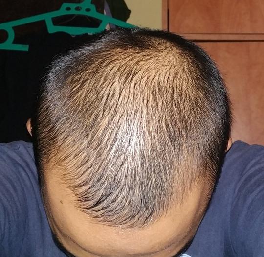 Rambut Rontok Kaskus - KibrisPDR