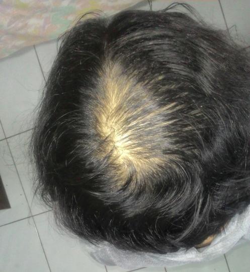 Detail Rambut Rontok Kaskus Nomer 2