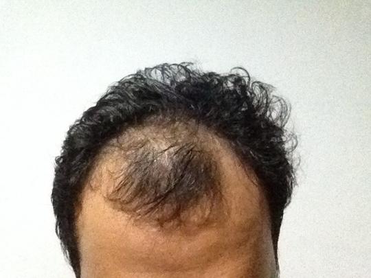 Detail Rambut Rontok Kaskus Nomer 11