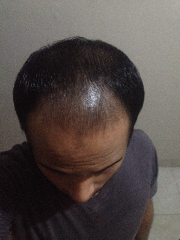 Detail Rambut Rontok Kaskus Nomer 12