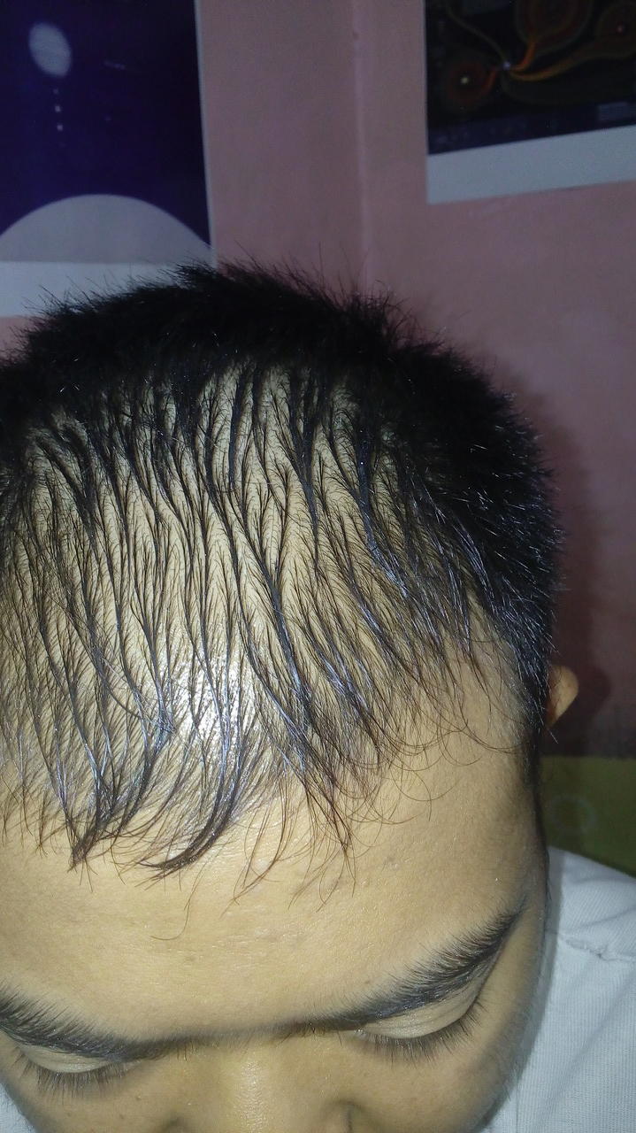 Detail Rambut Rontok Kaskus Nomer 13