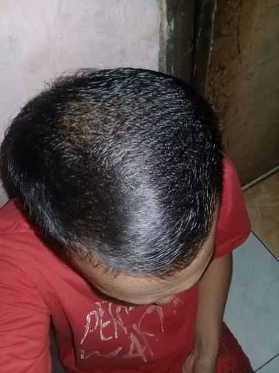 Detail Rambut Rontok Kaskus Nomer 14