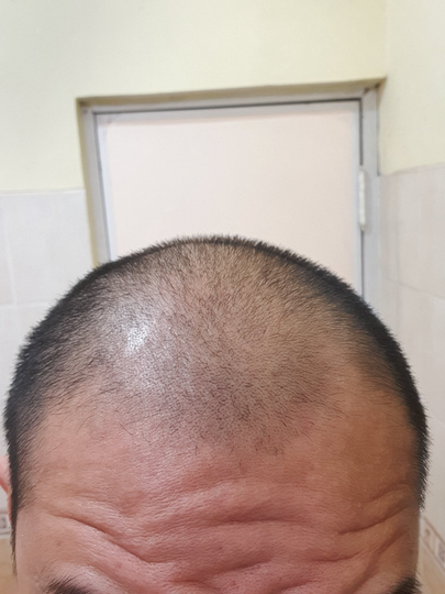 Detail Rambut Rontok Kaskus Nomer 15