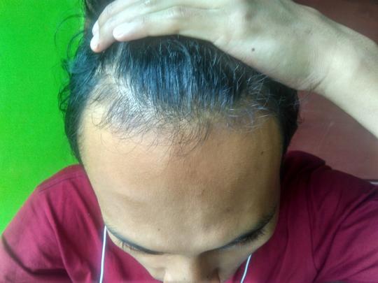 Detail Rambut Rontok Kaskus Nomer 17