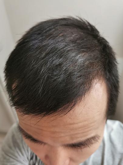 Detail Rambut Rontok Kaskus Nomer 18