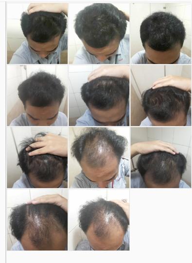 Detail Rambut Rontok Kaskus Nomer 3