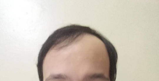 Detail Rambut Rontok Kaskus Nomer 21