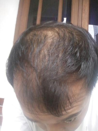 Detail Rambut Rontok Kaskus Nomer 22