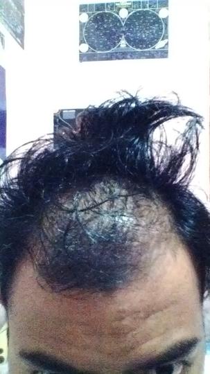Detail Rambut Rontok Kaskus Nomer 25