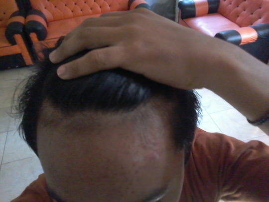 Detail Rambut Rontok Kaskus Nomer 26