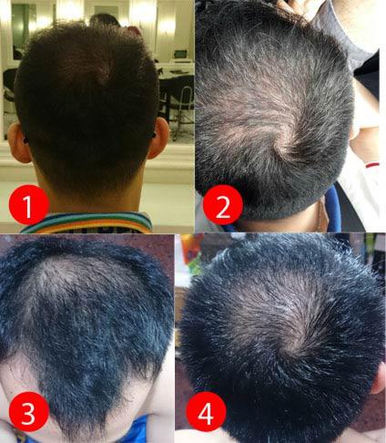 Detail Rambut Rontok Kaskus Nomer 28