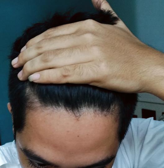 Detail Rambut Rontok Kaskus Nomer 4