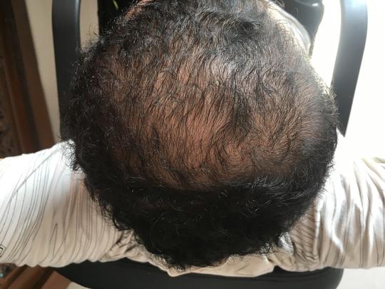 Detail Rambut Rontok Kaskus Nomer 30