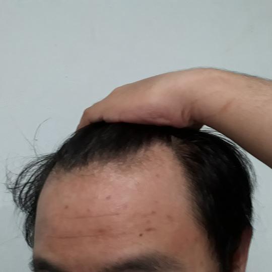 Detail Rambut Rontok Kaskus Nomer 37