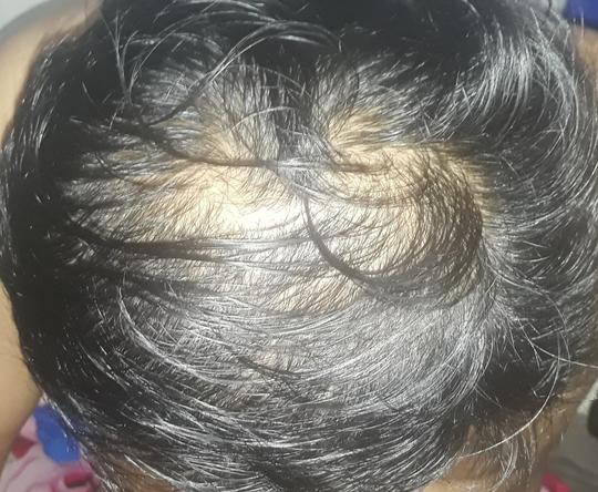 Detail Rambut Rontok Kaskus Nomer 5