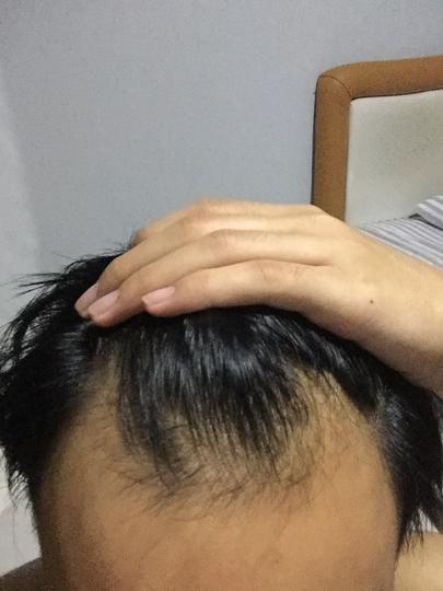 Detail Rambut Rontok Kaskus Nomer 39