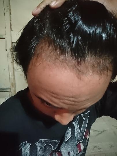 Detail Rambut Rontok Kaskus Nomer 41