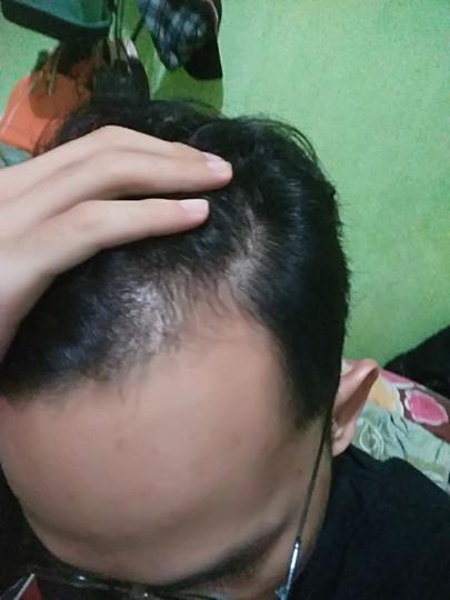 Detail Rambut Rontok Kaskus Nomer 43