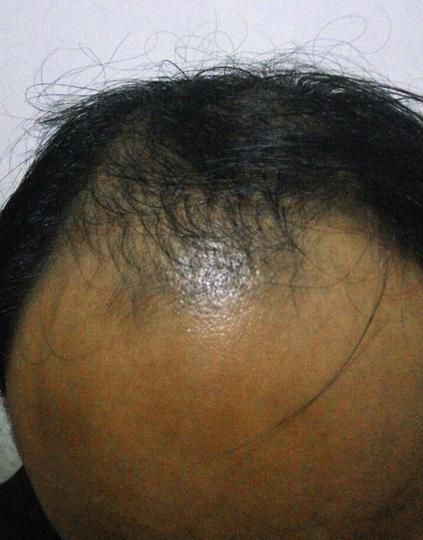 Detail Rambut Rontok Kaskus Nomer 47
