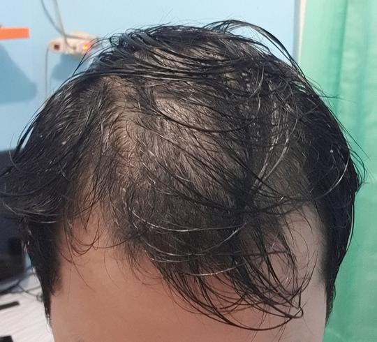 Detail Rambut Rontok Kaskus Nomer 6