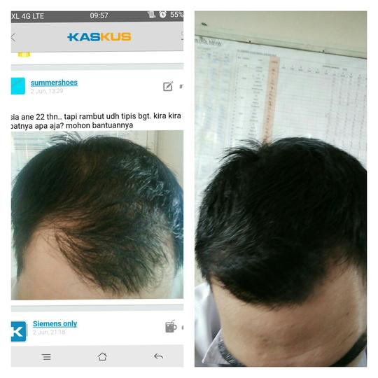Detail Rambut Rontok Kaskus Nomer 48