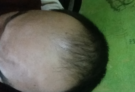 Detail Rambut Rontok Kaskus Nomer 51