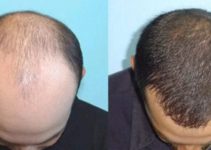 Detail Rambut Rontok Kaskus Nomer 52