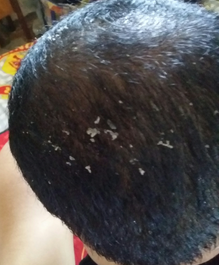 Detail Rambut Rontok Kaskus Nomer 56
