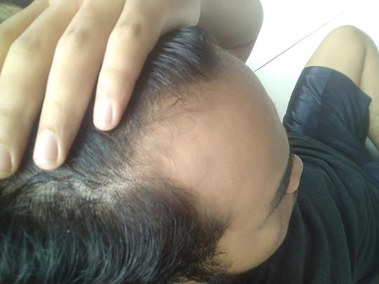 Detail Rambut Rontok Kaskus Nomer 7