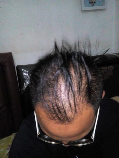 Detail Rambut Rontok Kaskus Nomer 8