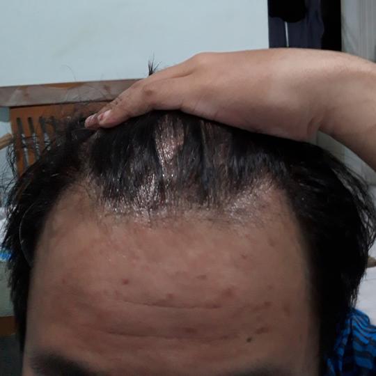 Detail Rambut Rontok Kaskus Nomer 9