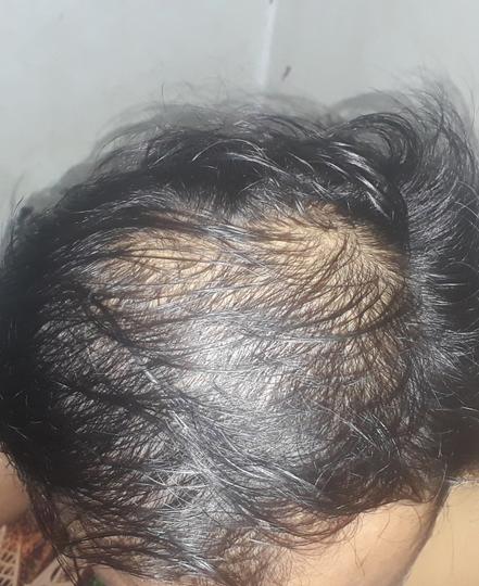 Detail Rambut Rontok Kaskus Nomer 10