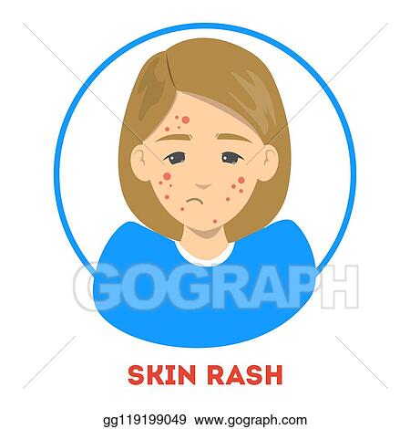 Detail Rash Clipart Nomer 37