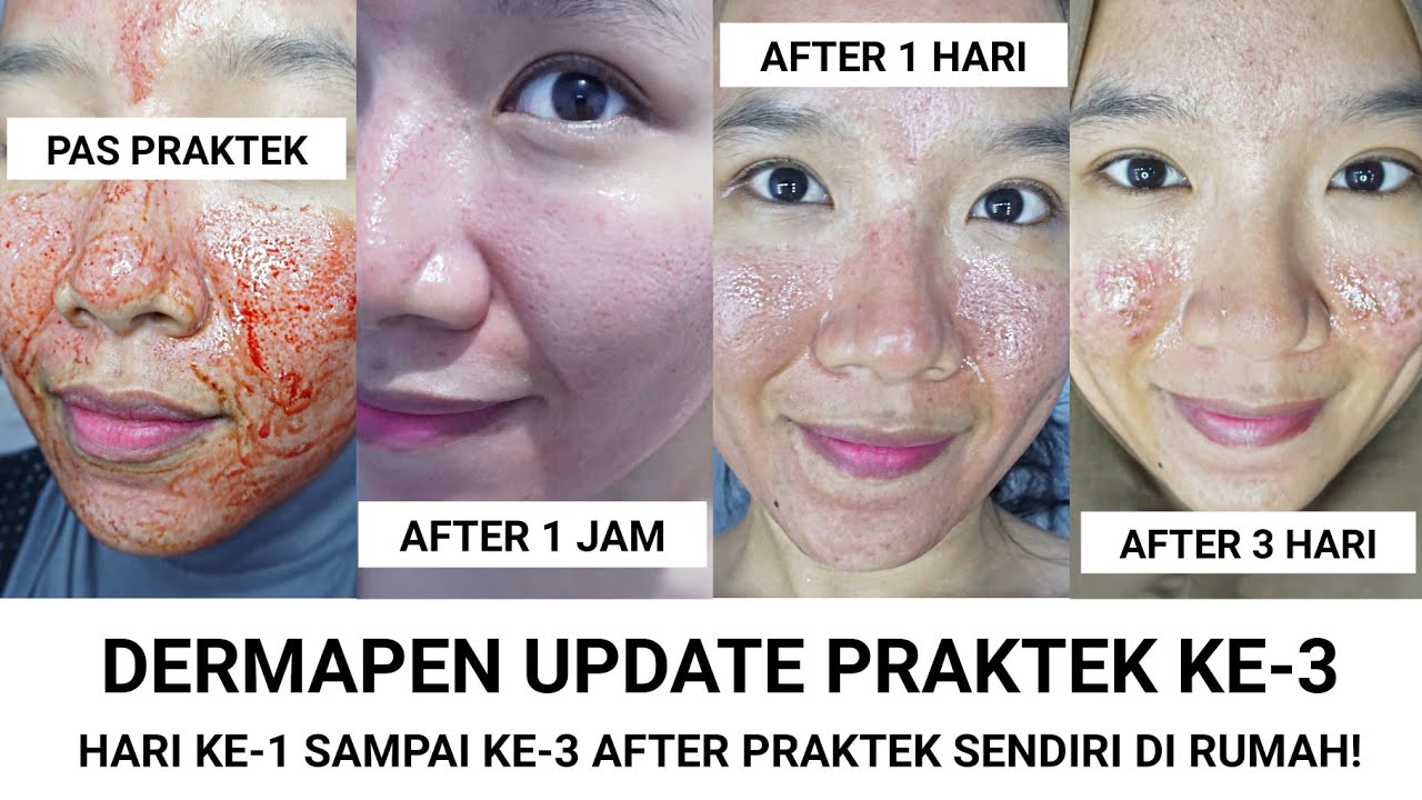 Review Dermapen Di Rumah - KibrisPDR