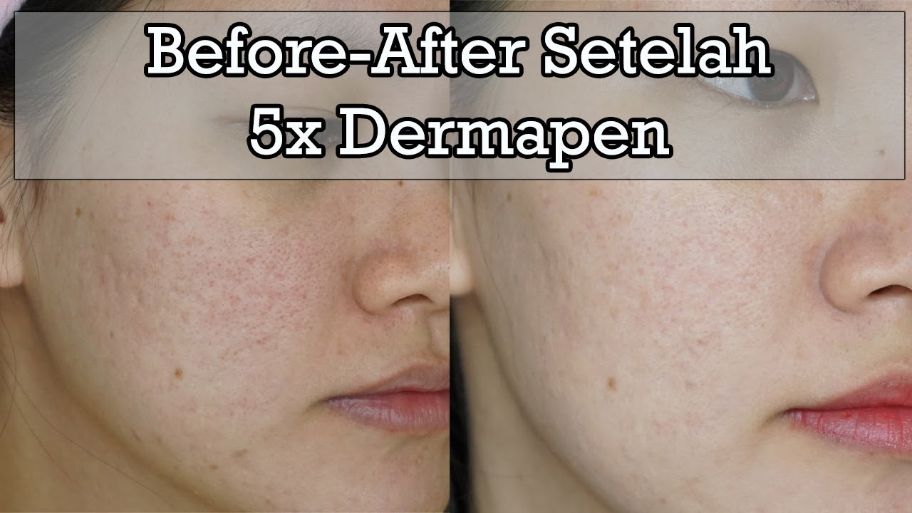 Detail Review Dermapen Di Rumah Nomer 2