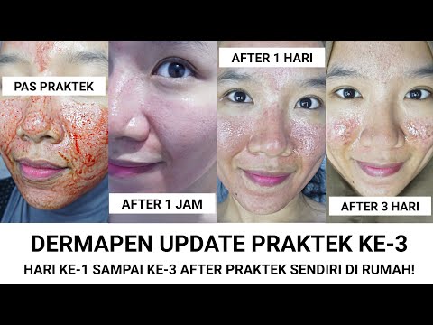 Detail Review Dermapen Di Rumah Nomer 13