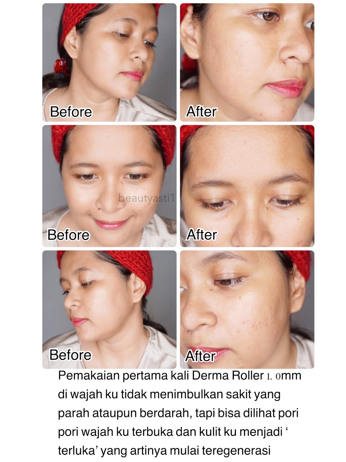 Detail Review Dermapen Di Rumah Nomer 19