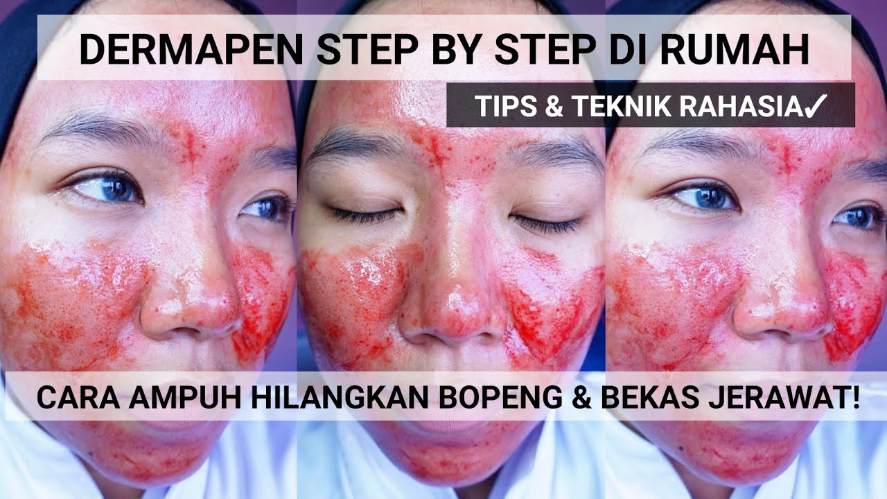 Detail Review Dermapen Di Rumah Nomer 4