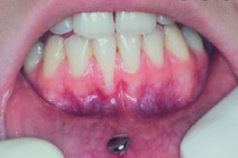 Detail Does Snake Eyes Piercing Mess Up Your Teeth Nomer 48