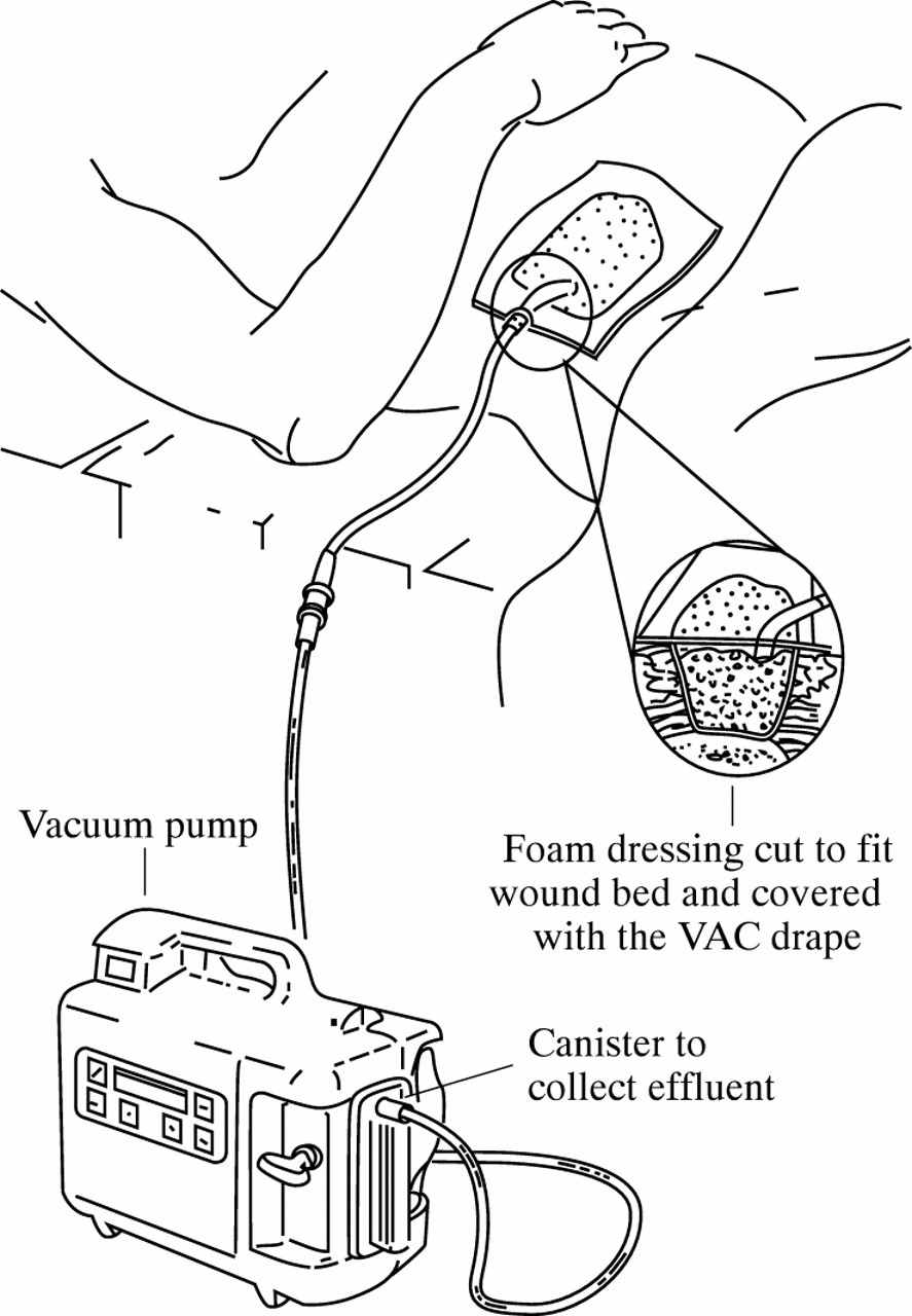 Detail Vac Pac For Wounds Nomer 19