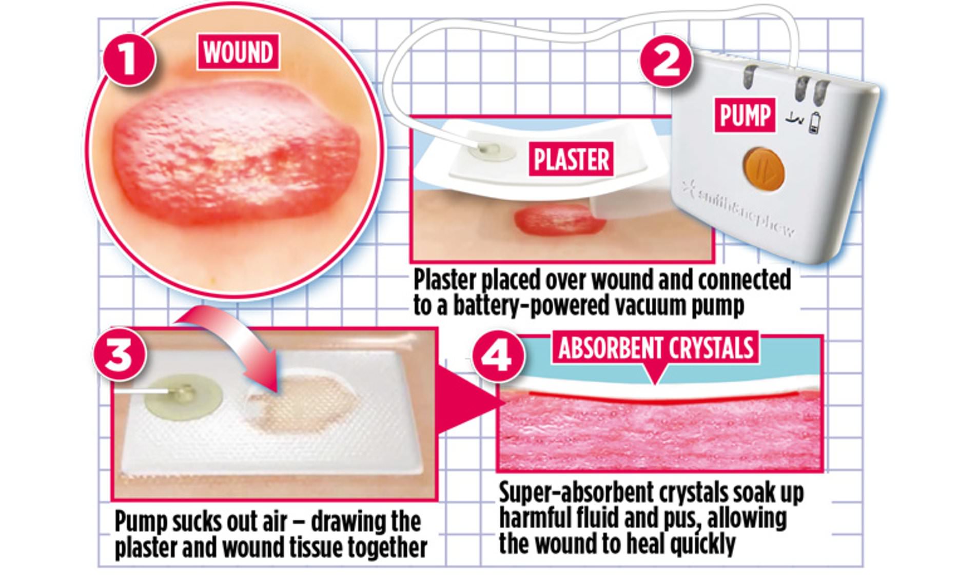 Detail Vac Pac For Wounds Nomer 33