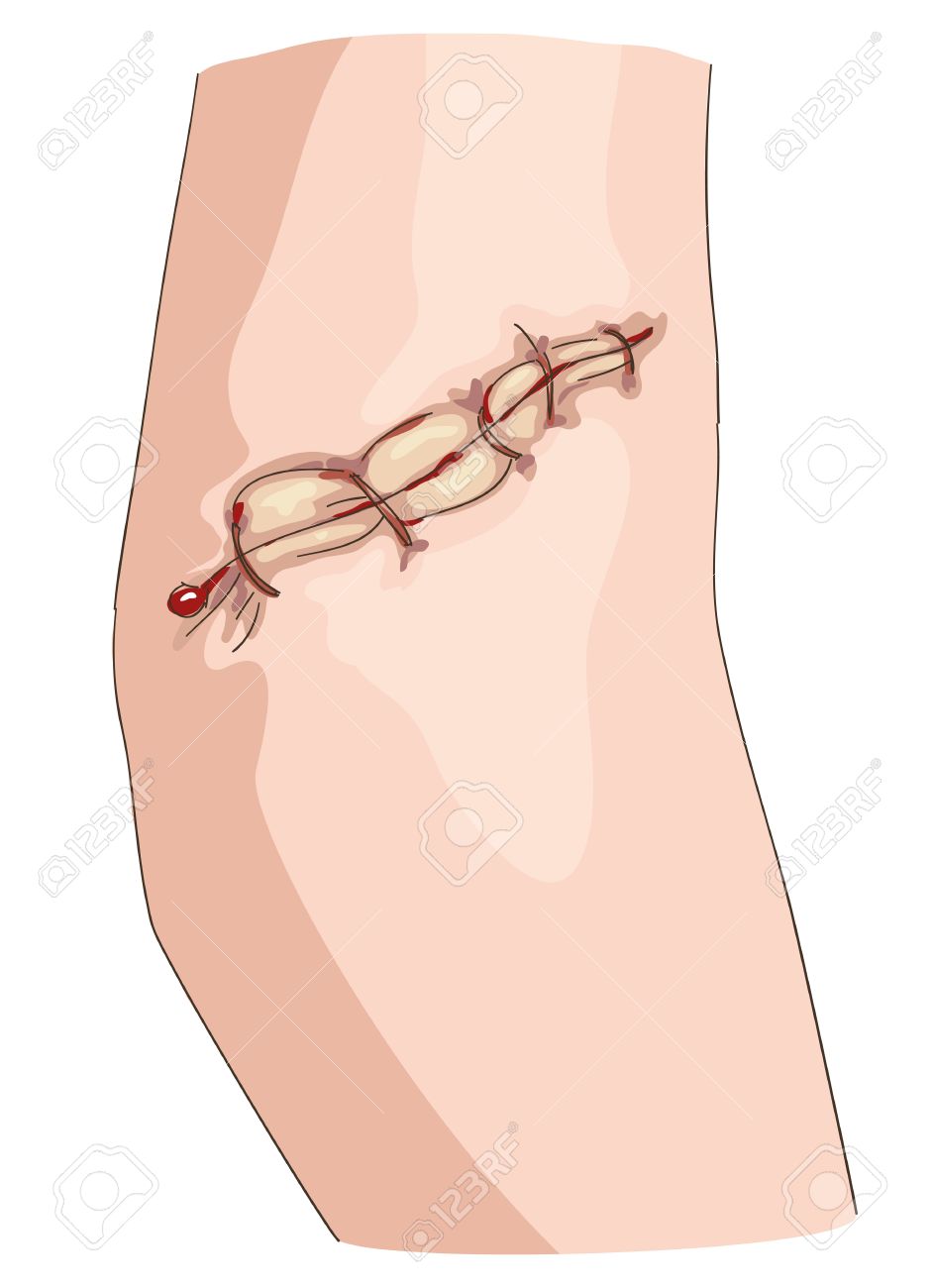 Detail Scar Wound Clipart Nomer 15