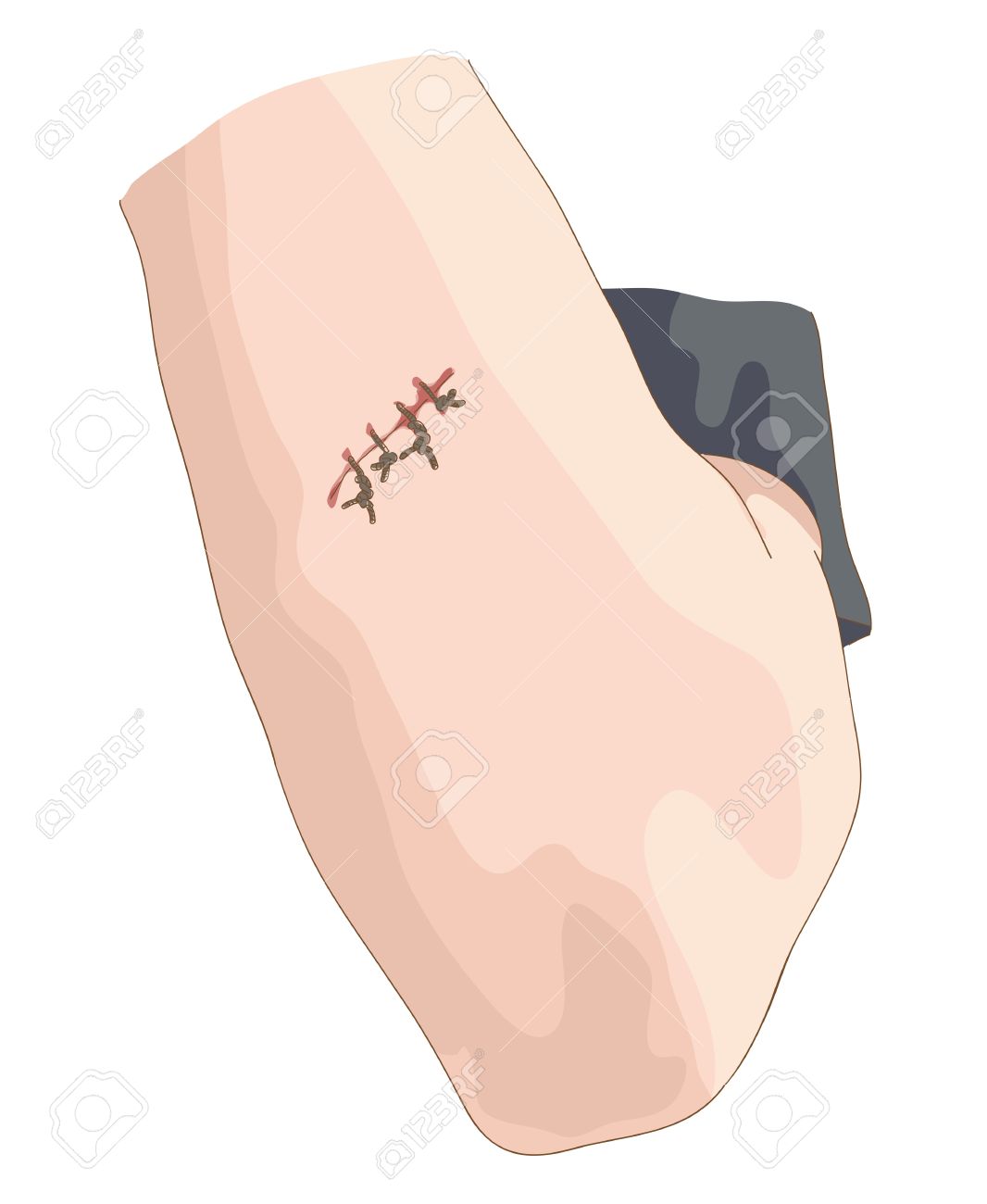 Detail Scar Wound Clipart Nomer 4